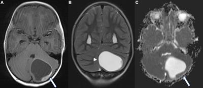 Unique Finding of a Primary Central Nervous System Neuroendocrine Carcinoma in a 5-Year-Old Child: A Case Report